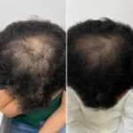 مقایسه ظاهر مو قبل و بعد از استفاده از شامپو مورینگا اکسونیک