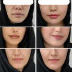 مقایسه ظاهر صورت قبل و بعد از مصرف پودر جوانه گندم بین استار