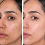 مقایسه ظاهر پوست قبل و بعد از استفاده از ضد آفتاب بی‌رنگ ویتابلا SPF 30
