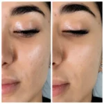 مقایسه ظاهر پوست قبل و بعد از استفاده از سرم هیالورونیک اسید لاکچری کوین